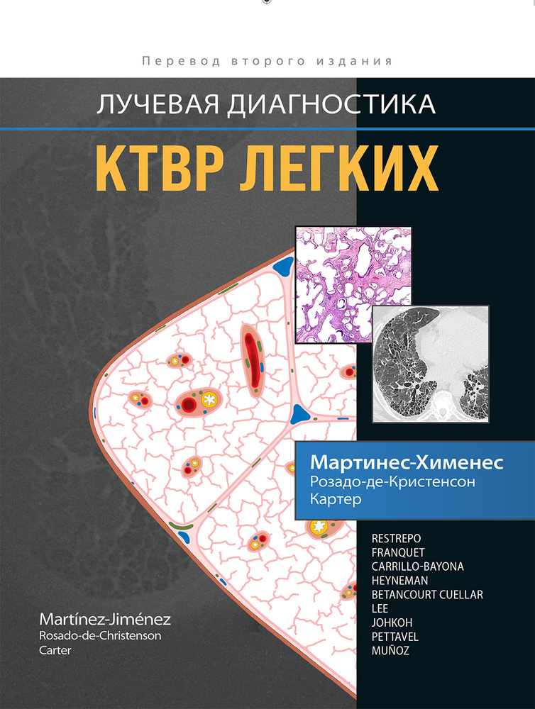 Лучевая диагностика. КТВР легких #1