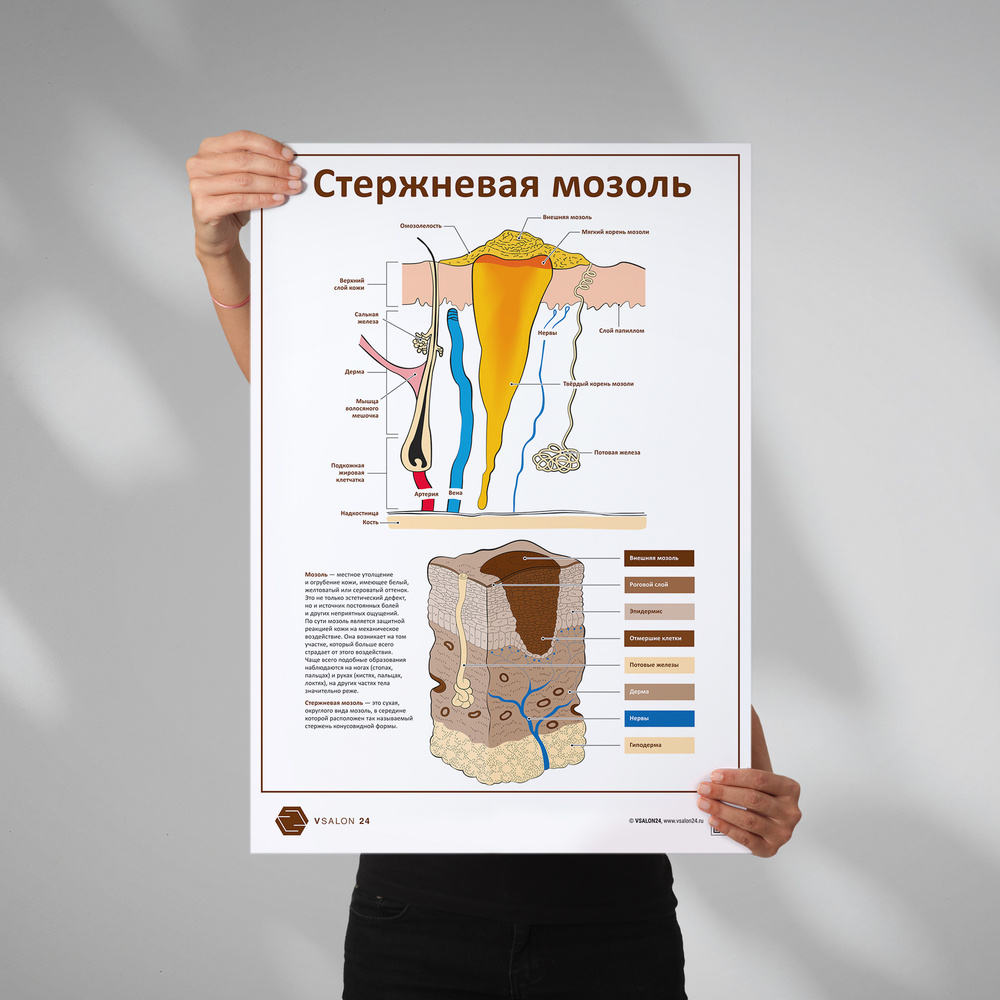 Плакат Стержневая мозоль для кабинета педикюра и подолога в формате А1 (84 х 60см), версия 2  #1