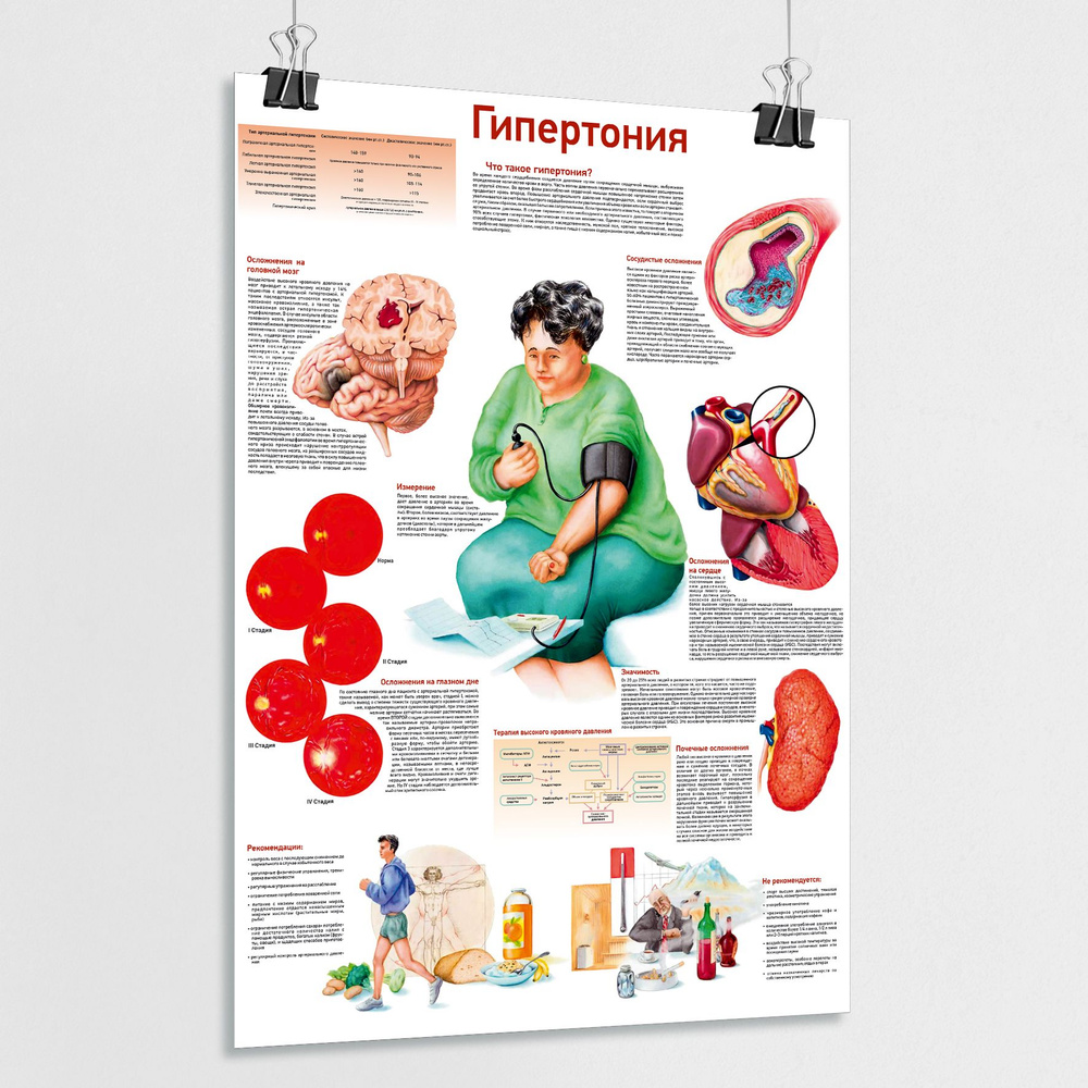 Ламинированный плакат "Гипертония" / А-2 (42x60 см.) #1