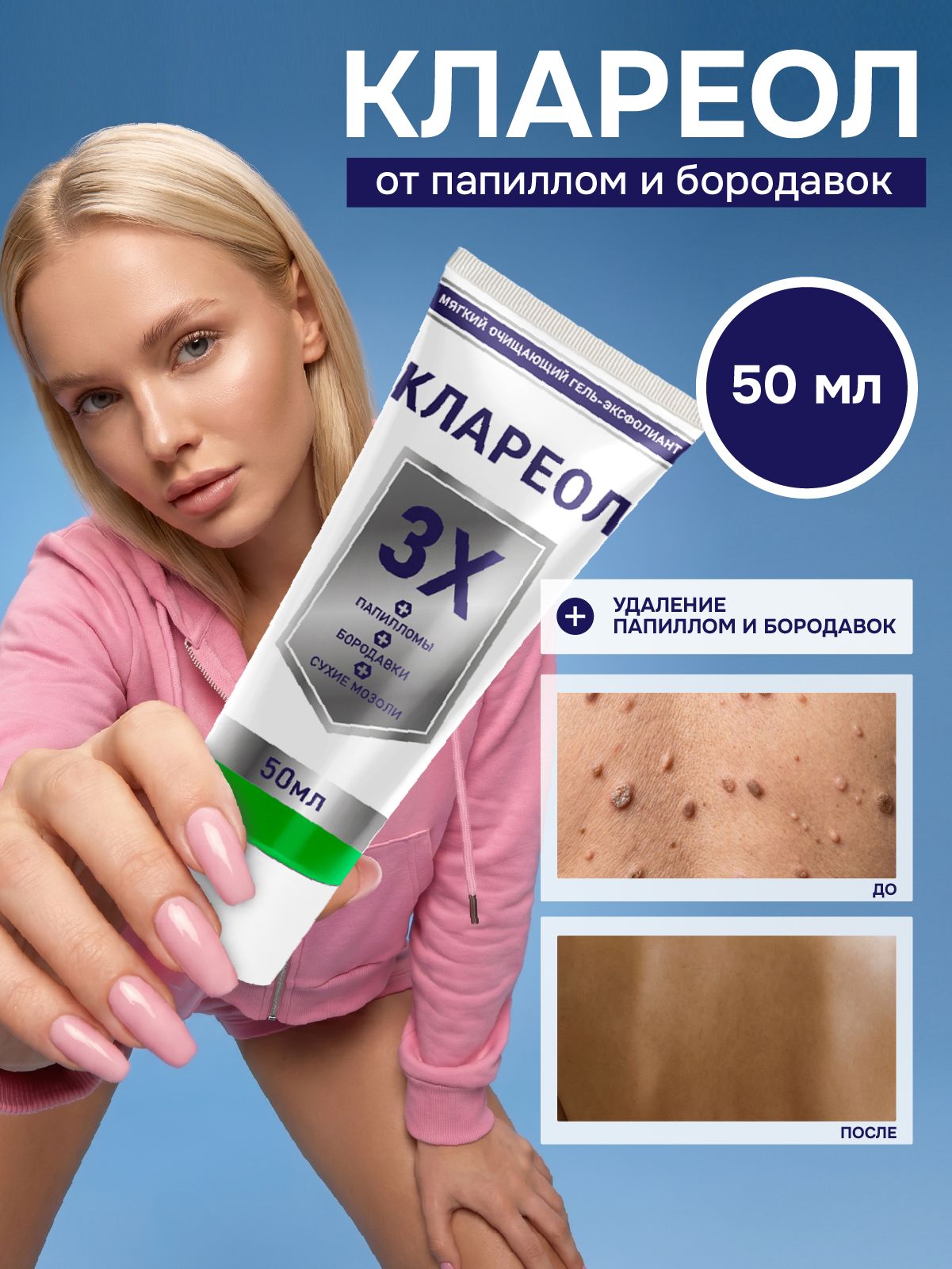 Клареол:кремдляудаленияпапилломибородавок