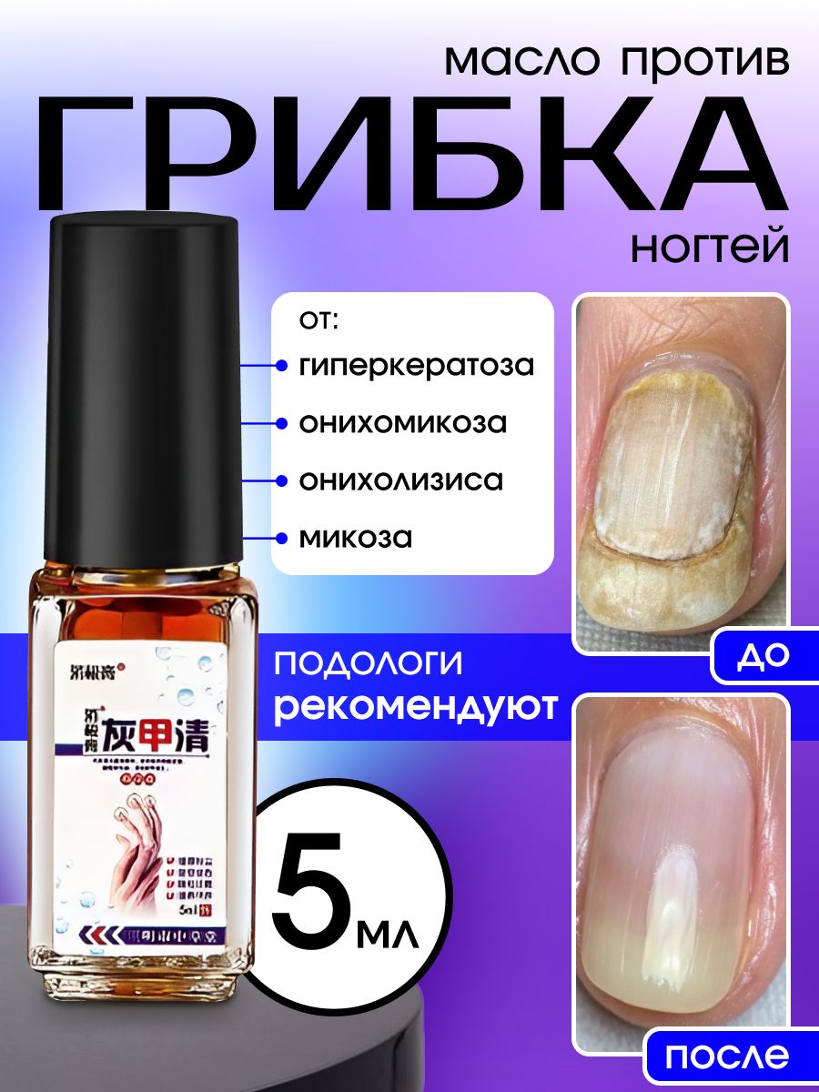 Маслодляногтейотгрибка,средстводлялечениягрибкаNovo,5мл.,лечениеонихолизиса
