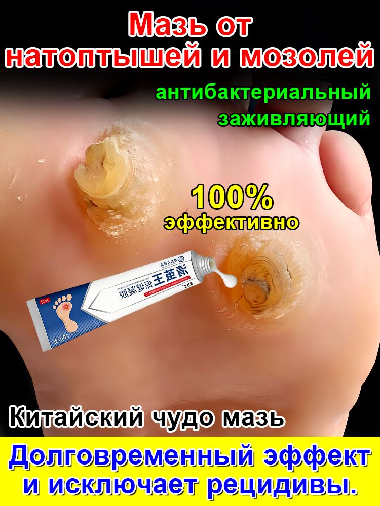 Mазьотмозолейстержневыхинатоптышей,Кремотсухихмозолей,шипицы,бородавок,натоптышей,20г.