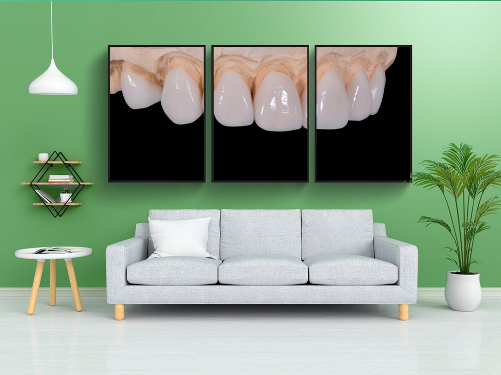 Printstar Постер "стоматологическая, фарфоровые зубы, воск разделенные запятыми", 180 см х 90 см  #1