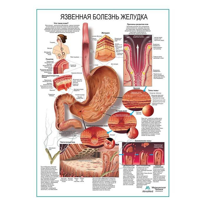 Язвенная болезнь желудка (анатомия человека) плакат глянцевый А1+, плотная фотобумага от 200г/м2  #1