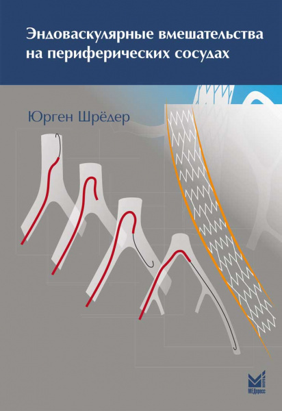 Эндоваскулярные вмешательства на периферических сосудах  #1