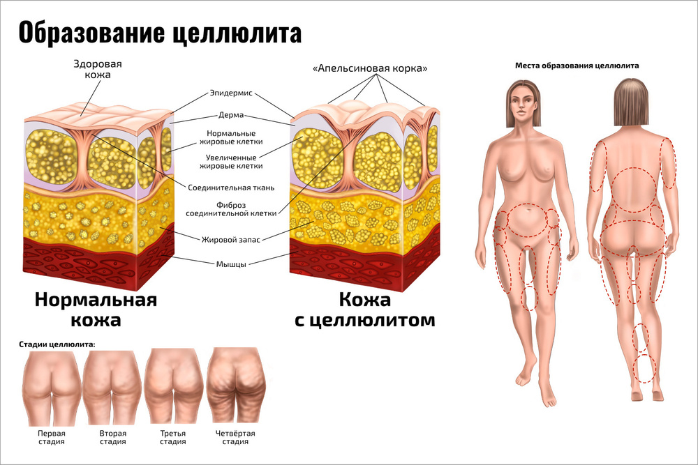 Плакат А2 ламинир. обучающий Образование целлюлита медицинский плакат по косметологии и массажу 457x610 #1