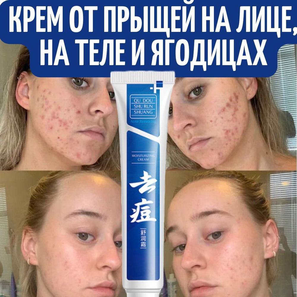 Точечный крем от прыщей на лице, ягодицах, теле для подростков и ...