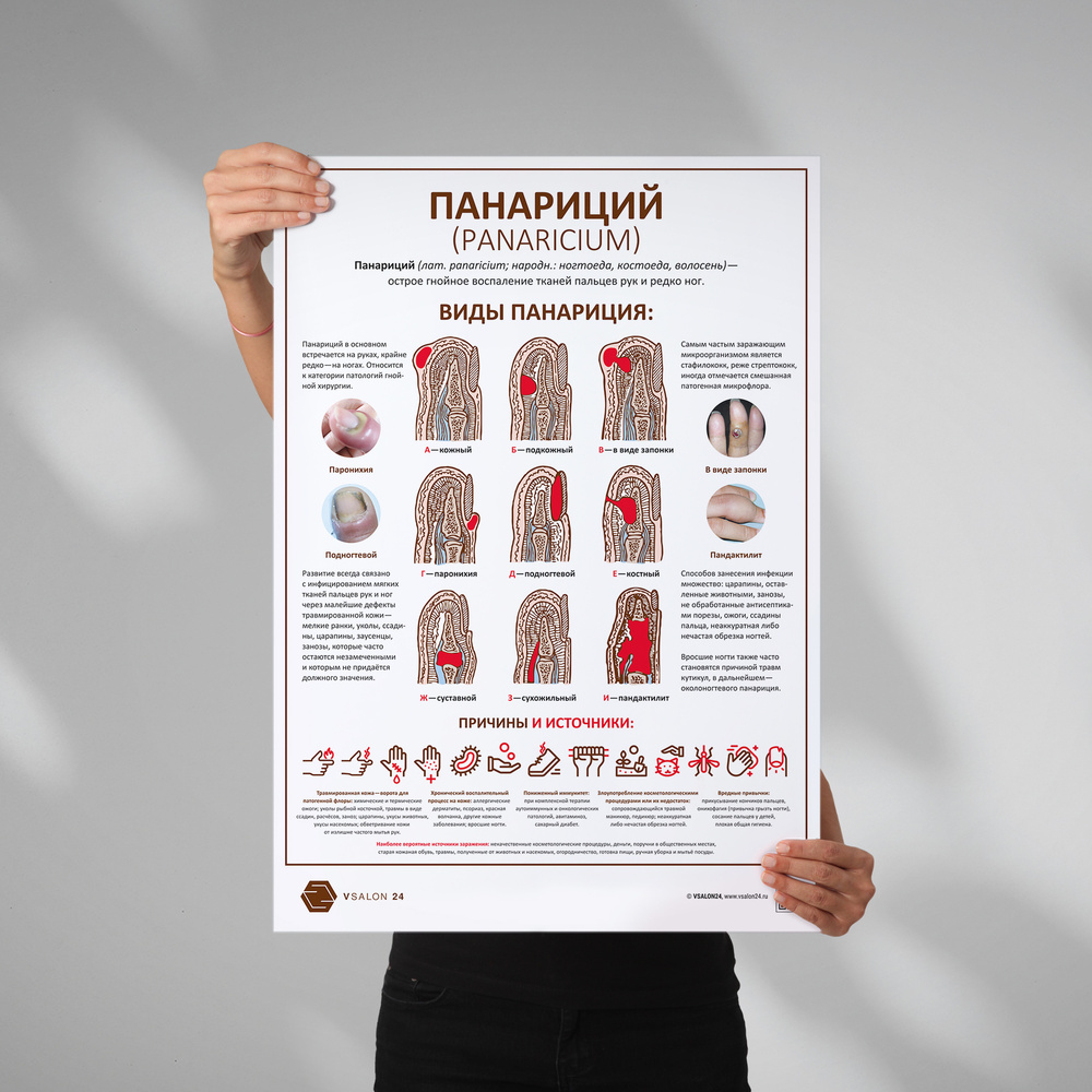 Плакат Панариций для кабинета педикюра и подолога в формате А1 (84 х 60см)  #1