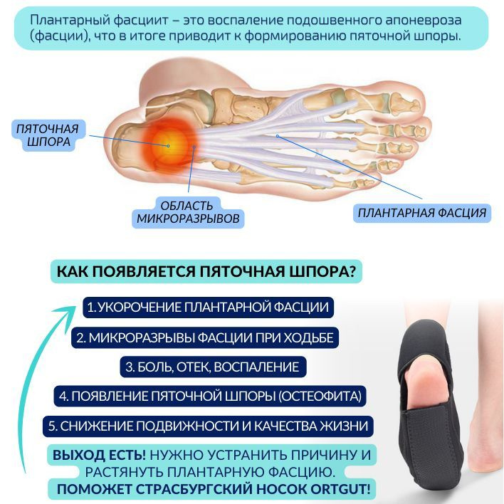 Как лечить пяточную шпору