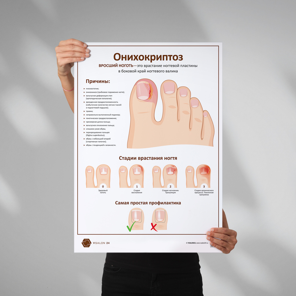 Плакат Онихокриптоз для кабинета педикюра и подолога в формате А1 (84 х 60 см)  #1