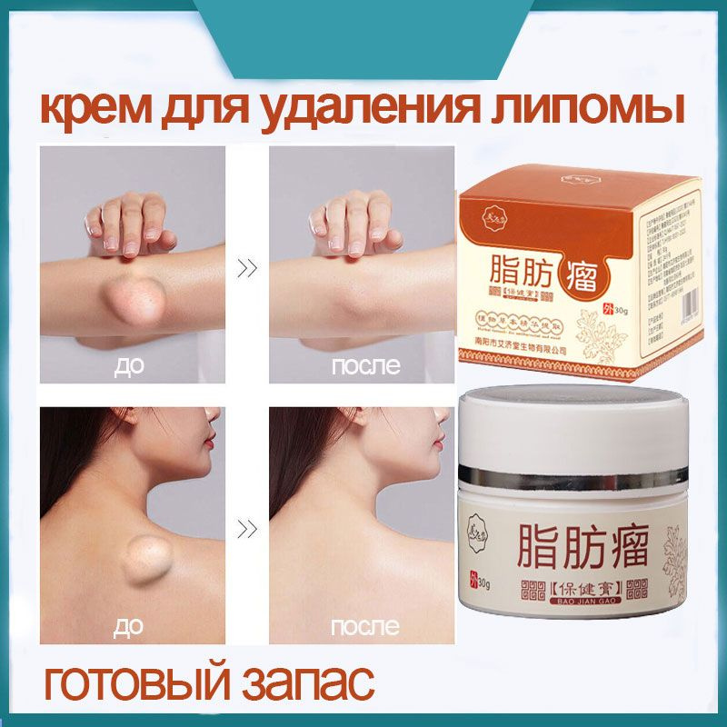 Мазь от липомы и жировиков 30 г, для липолиза, узелкового дискомфорта и ...