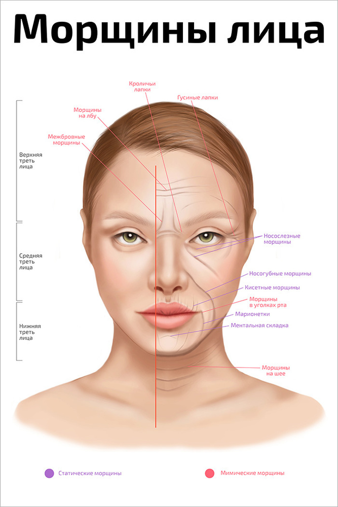 Плакат обучающий А2 ламинир. Морщины лица косметологический 457x610 мм  #1