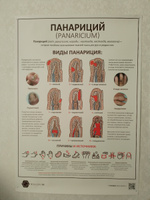 Плакат Панариций для кабинета педикюра и подолога в формате А1 (84 х 60см) #2, Наталья Р.