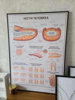 Плакат Ногти человека в кабинет педикюра и подолога в формате А1 (84 х 60 см) #1, Анастасия К.