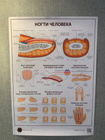 Плакат Ногти человека в кабинет педикюра и подолога в формате А1 (84 х 60 см) #3, Камилла Е.