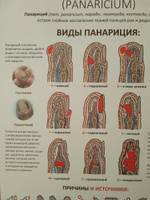Плакат Панариций для кабинета педикюра и подолога в формате А1 (84 х 60см) #3, Наталья Р.